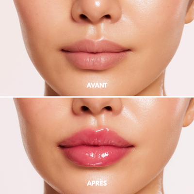 LipBoost - Microneedling Lèvres